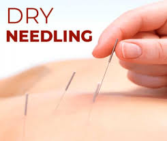 Dry Needling Therapy